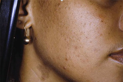 5 best remedies for black spots and acne